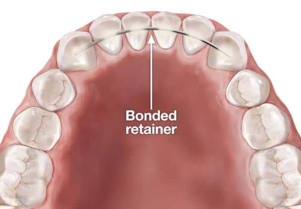 bonded-retainer